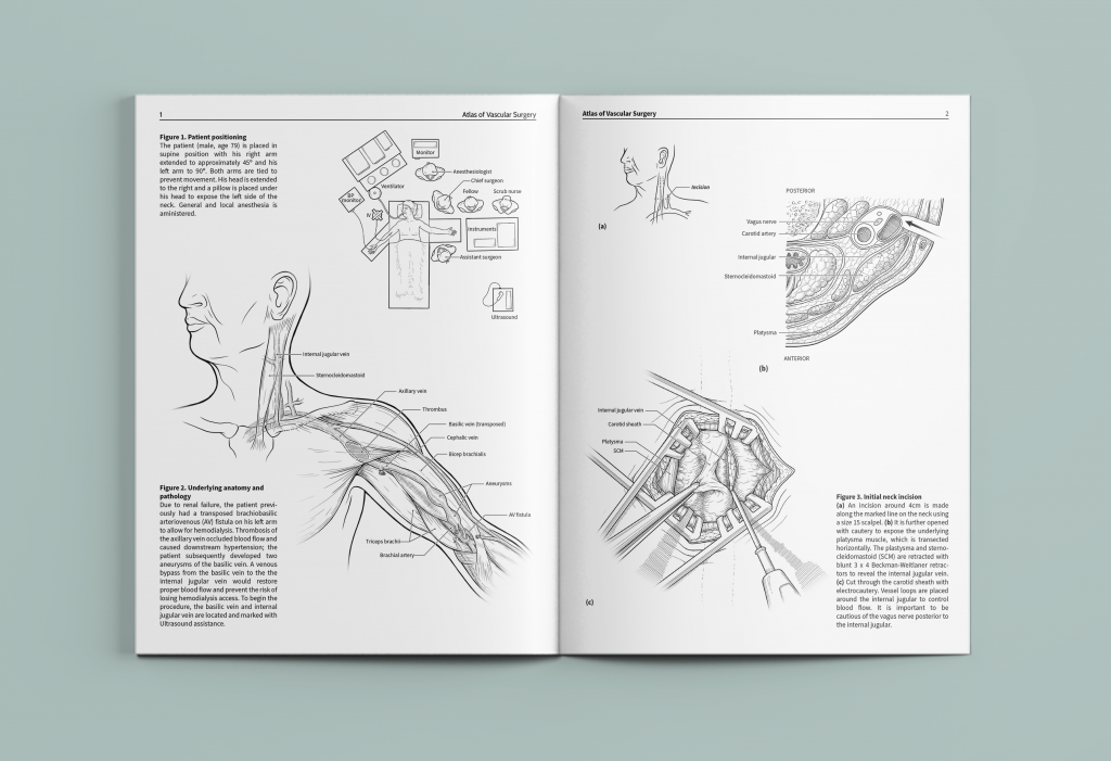 Surgical Illustration by Avesta Rastan.  A image which shows a surgical illustration. An atlas of a vascular surgery. 