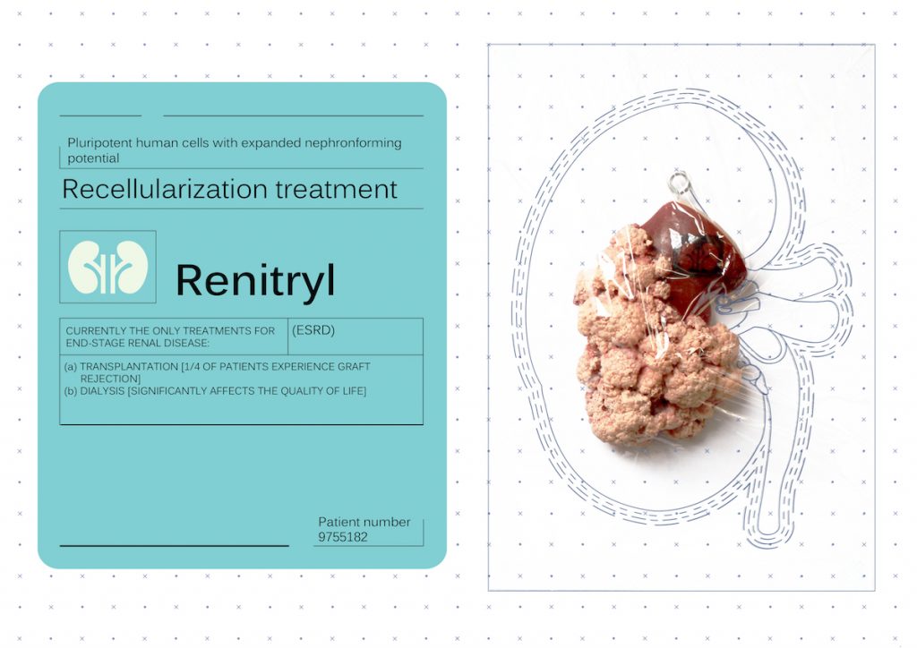 An artificial portion of a kidney described as a recellularization treatment for renal disease.