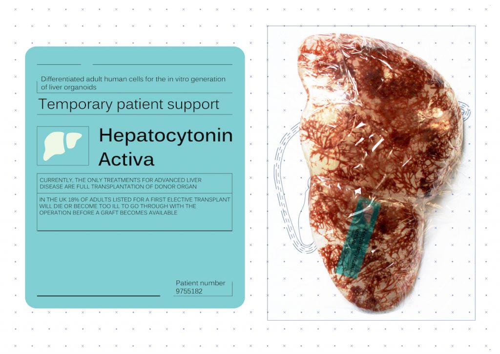An artificial liver with blood vessels described as a temporary patient support.