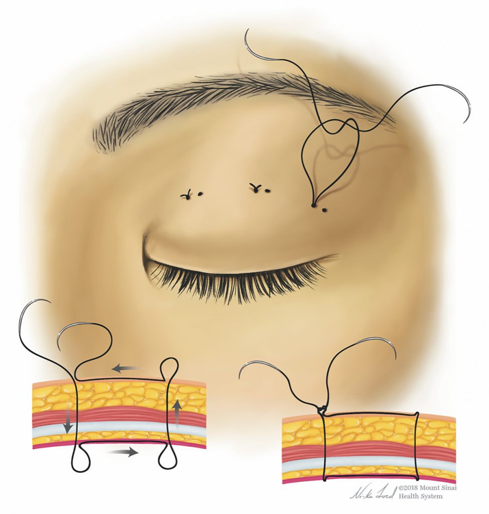 Illustration of sutures on a closed eyelid. Below is an illustration of the the direction the thread goes in the different skin layers. 