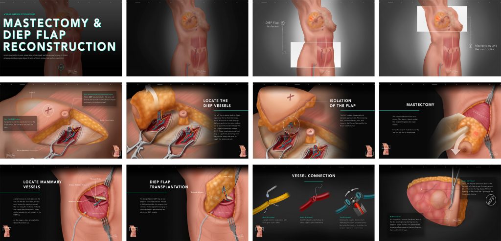 DIEP Flap Breast Reconstruction Procedure information website mockup (2019) made by Tiffany Fung. A complete presentation of mastectomy and diep flap reconstruction.