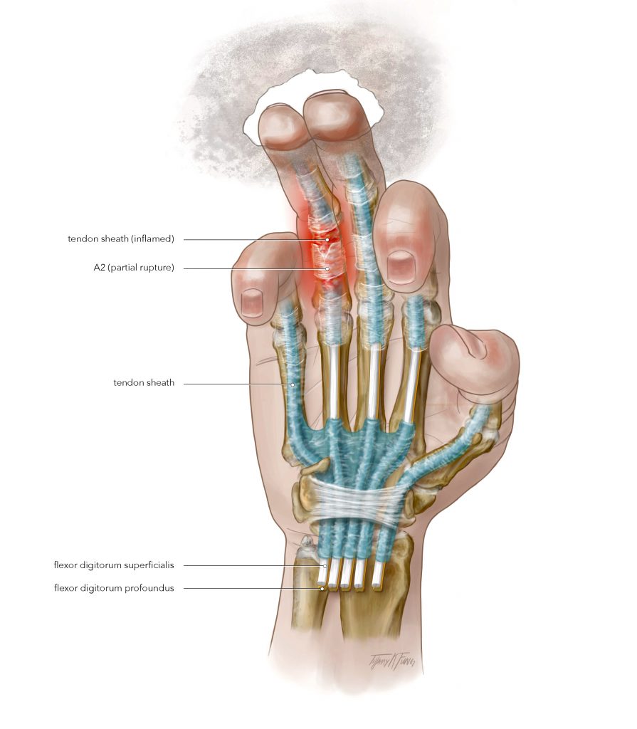 Tenosynovitis illustration (2019) made by Tiffany Fung. A pictorial representation of tenosynovitis an is inflammation of a tendon and its synovium. 