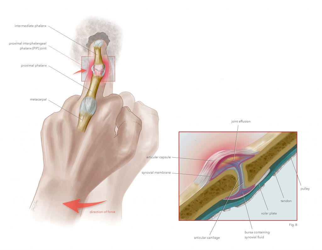 PIP Joint Capsulitis illustration (2019) made by Tiffany Fung with a close up view.