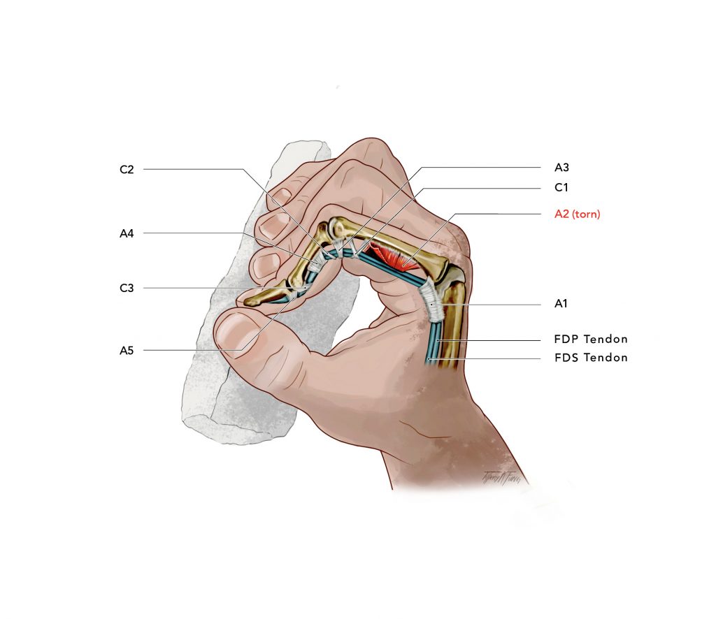 Pulley Rupture illustration (2019) made by Tiffany Fung. A hand with tendon view. 