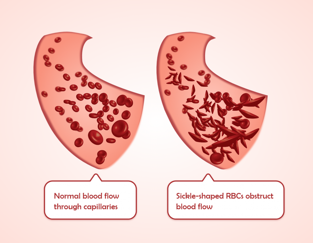 A snippet form of 2D animation - What happens in sickle cell anemia it shows the normal blood flow through capillaries vs what happens in the sickle shaped RBCs. by Rutuja Chalke