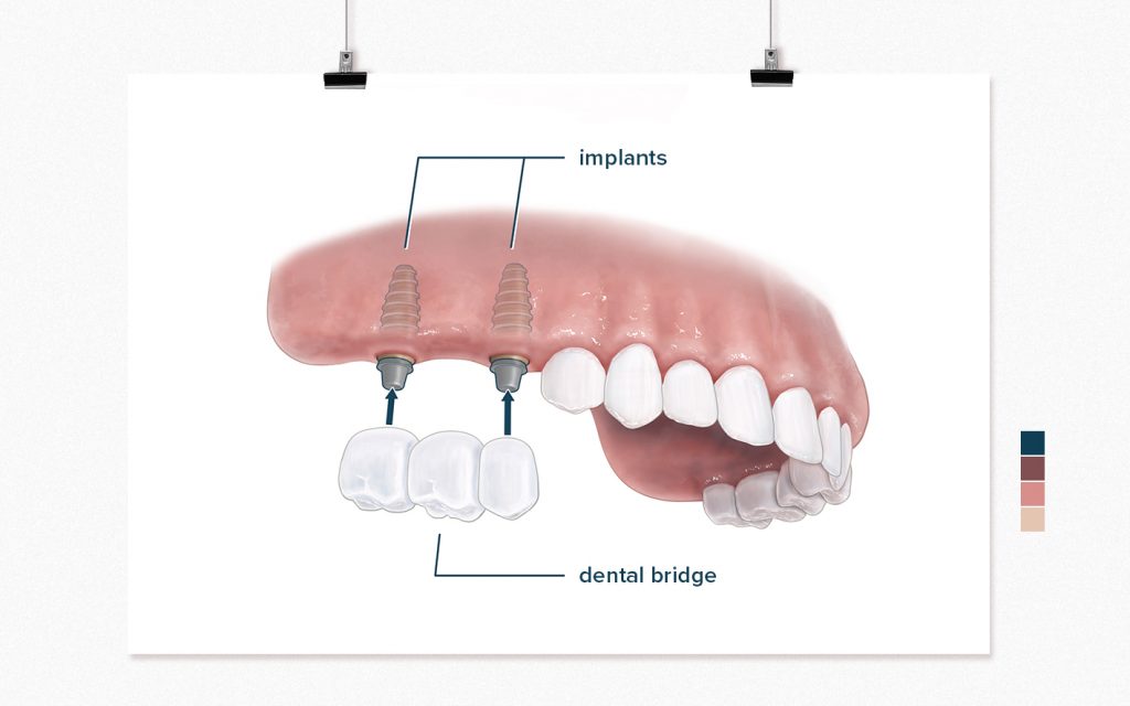 An Illustration of a traditional dental bridge showing an open mouth with implants  by Diogo Guerra