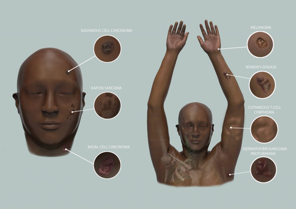 Skin Cancer Presentation in Dark Skin (Credit to University of Dundee) by Amie Fernandez