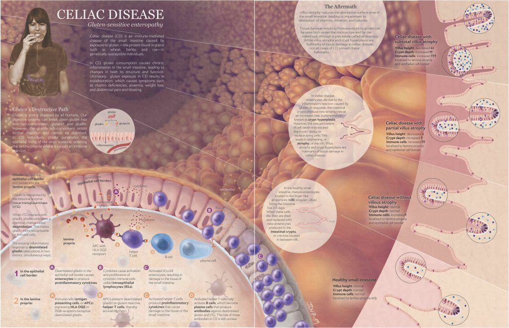 A poster representing pathology of celiac disease which is an immune mediated disease of the small intestine.