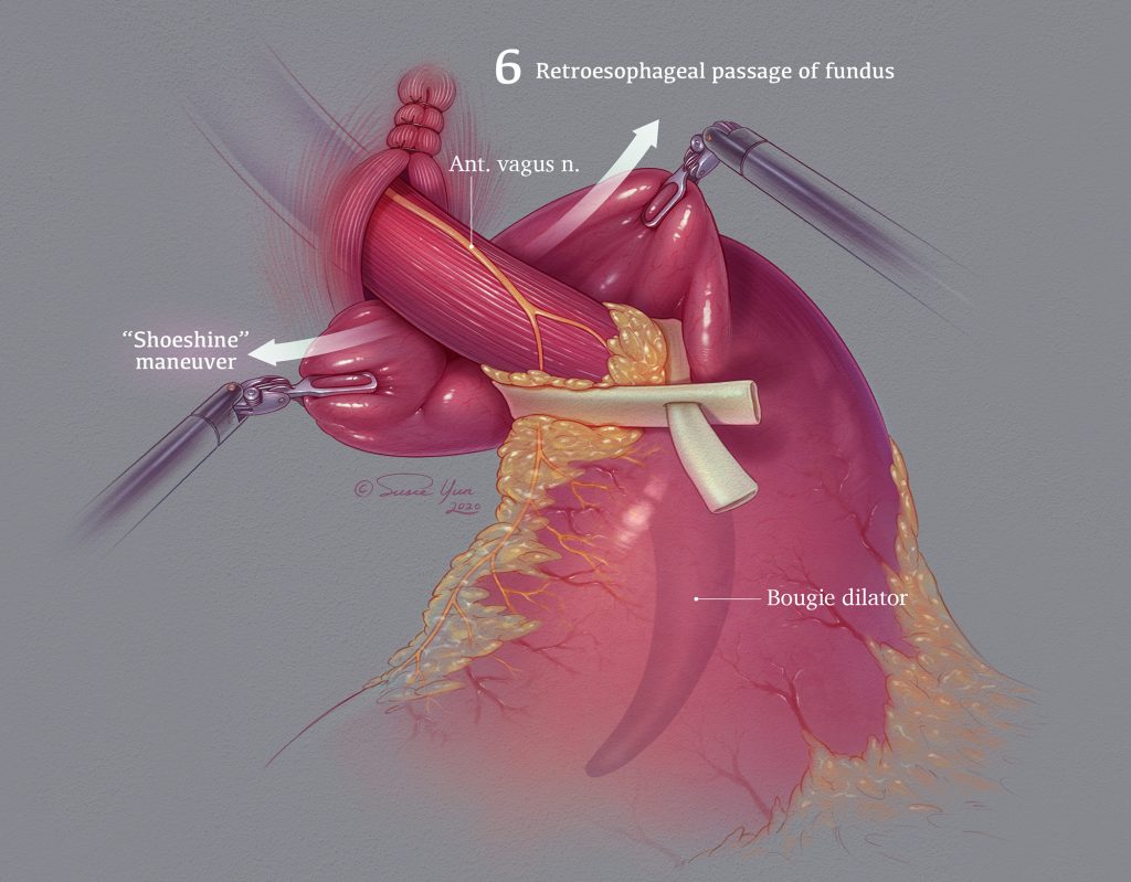 The coloured image represents hernia repair.