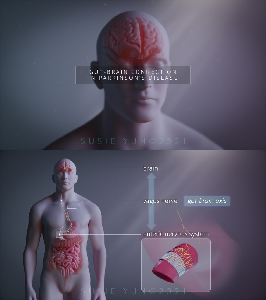 The image displays the anatomy of gut-brain connection in Parkinson's disease along with zoomed-in enteric nervous system.  